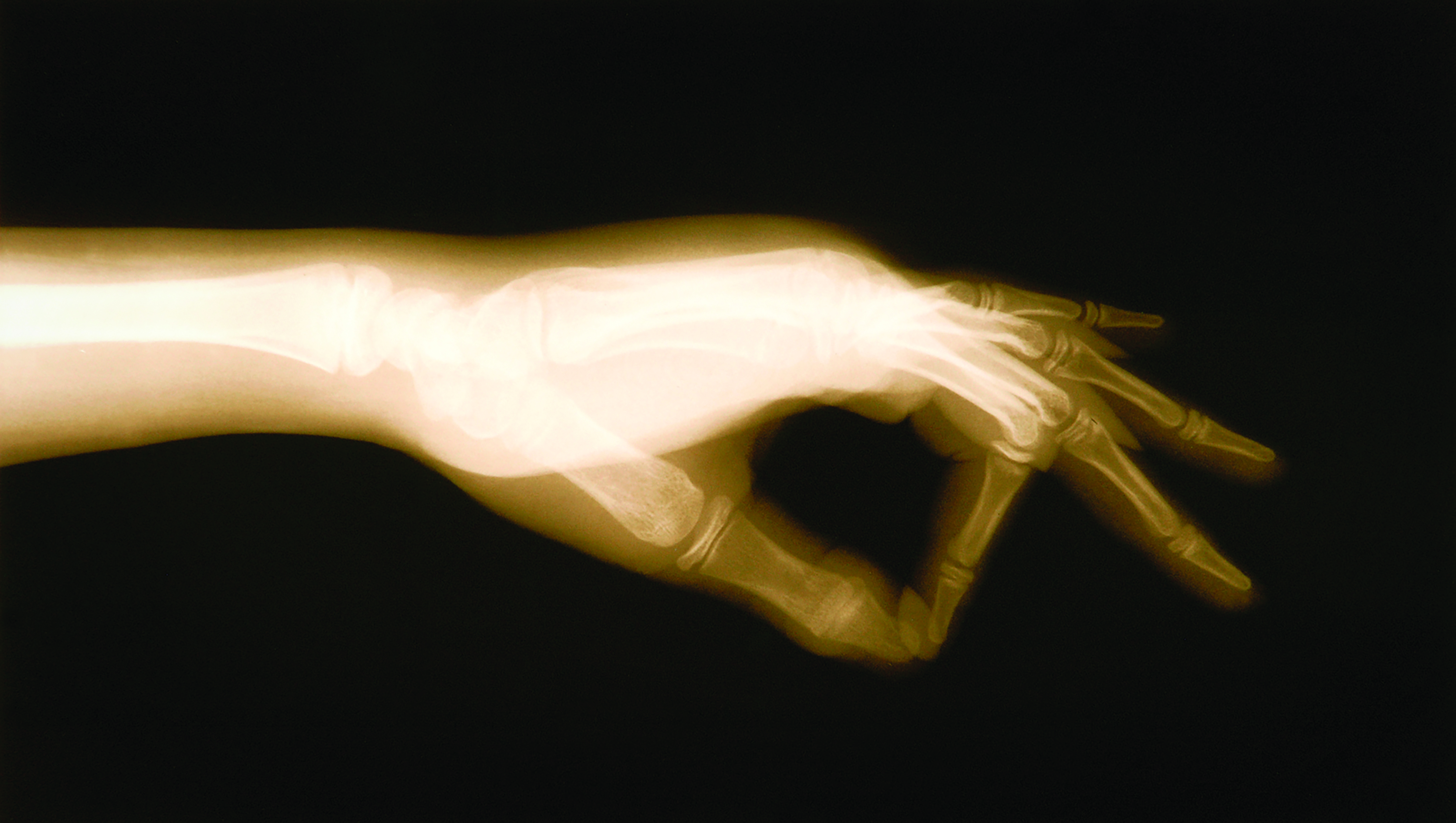 A X-ray of hand, sepia-toned
